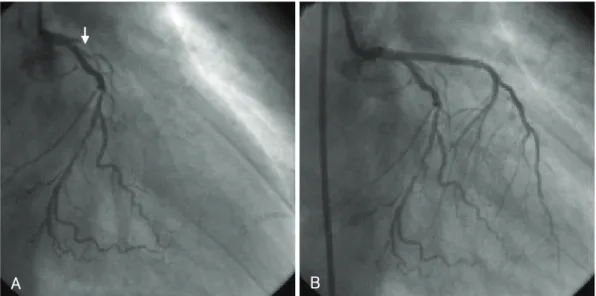 Fig. 2. The first follow-up coronary angiogram and percutaneous coronary intervention for restenosis