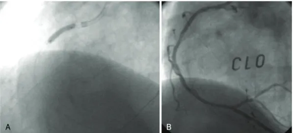 Fig. 6. Percutaneous coronary intervention for the very late stent thrombosis in right coronary artery
