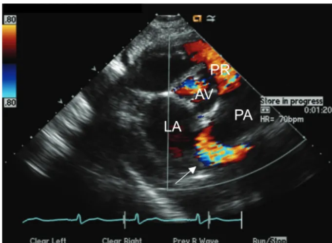 Fig. 2. The electrocardiogram showed atrial fibrillation, left ventricular hypertrophy and T wave inversion accompanied by ST-segment de- de-pression in V3-V6