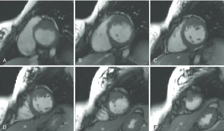 Fig. 4. Consecutive static images of short axis cines {steady-state free precession (SSFP)} in diastole (A-F)