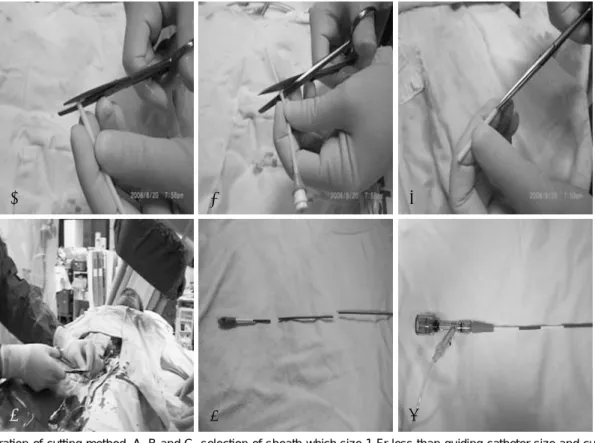 Fig. 1. Illustration of cutting method. A, B and C: selection of sheath which size 1 Fr less than guiding catheter size and cutting off the  sheath about 4 cm length