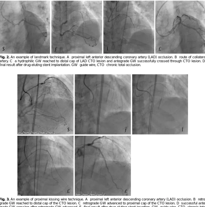 Fig. 3. An example of proximal kissing wire technique. A: proximal left anterior descending coronary artery (LAD) occlusion