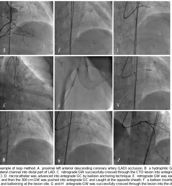 Fig. 4. An example of loop method. A: proximal left anterior descending coronary artery (LAD) occlusion