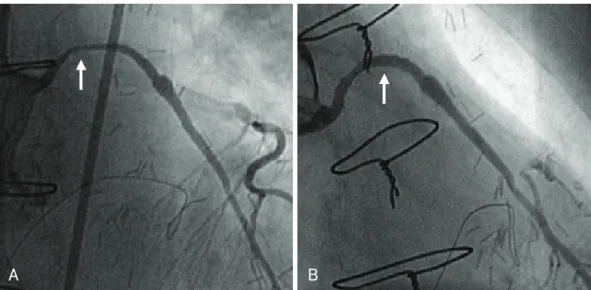 Fig. 1. Angiographic views of SVG to the left anterior descending artery during the initial coronary intervention