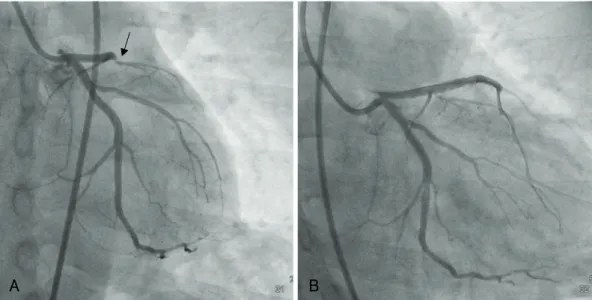 Fig. 2. Left coronary angiogram showed total occlusion of the left anterior descending artery (arrow) (A) and the lesion was treated with two  sirolimus-eluting stents (B)