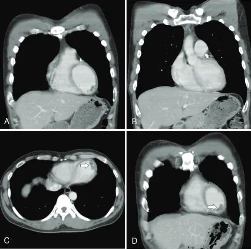 Fig. 4. A follow-up chest CT (coronal view; A, B and D and axial view; C) showed that the previously noted soft tissue density lesion sur- sur-rounding ascending aortic wall and subtle streaky fatty infiltrations with a small gas bubble had resolved