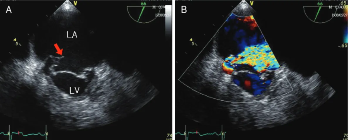 Fig. 2. Transesophageal echocardiography. A: the medial segments of both leaflets (P3 and A3 segments) revealed flail motion and  ruptured chordae (red arrow)
