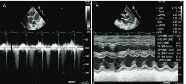 Fig. 4. The inhaled iloprost increased the oxygenation (saturation >95%). Serial echocardiograms showed mild elevated pulmonary pres- pres-sure, with a TR PG of 34 mmHg (A) and a decrease in the size of the RV (B)
