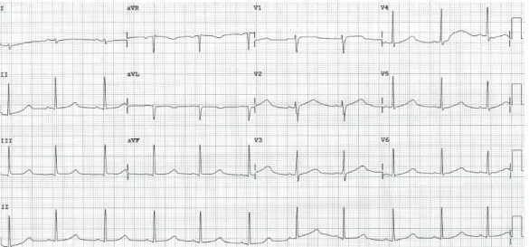 Fig. 1. Routine ECG showing sinus rhythm with markedly prolonged QT (528 ms) and QTc (562 ms) intervals