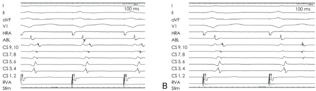 Fig. 3. Surface ECG and electrogram recordings during ventricular pacing. A: early retrograde sharp atrial potential representing coro- coro-nary sinus activity (arrow)