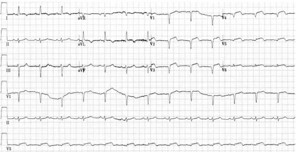Fig. 3. The electrocardiogram showed newly developed ST-segment elevation in V1-V5.