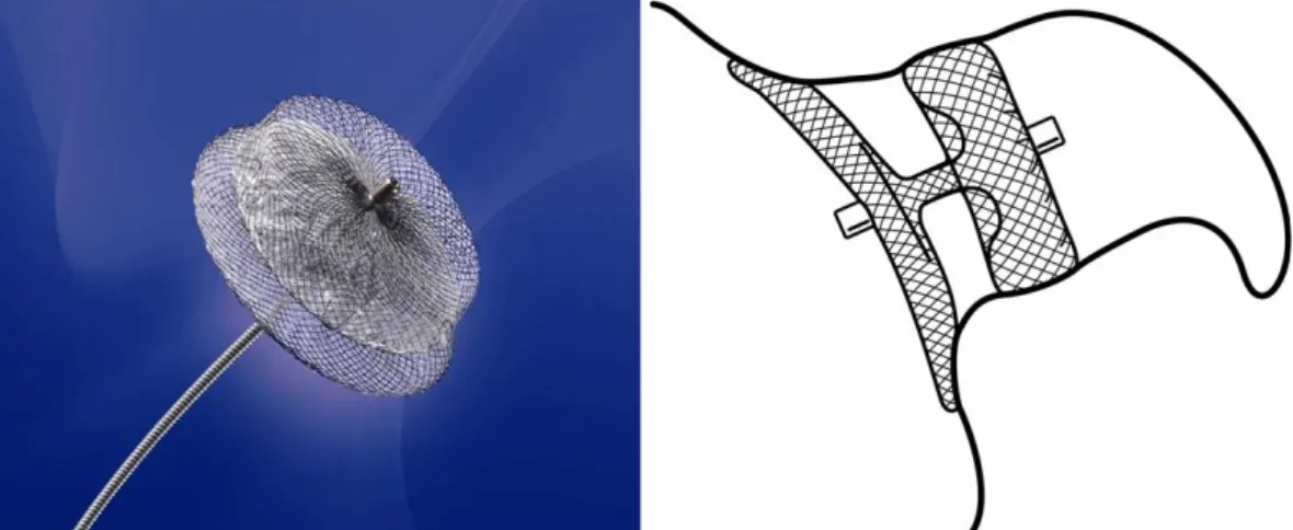 Fig. 2. The AMPLATZER Cardiac Plug (ACP). On the right, the ideal position within the LAA is sketched