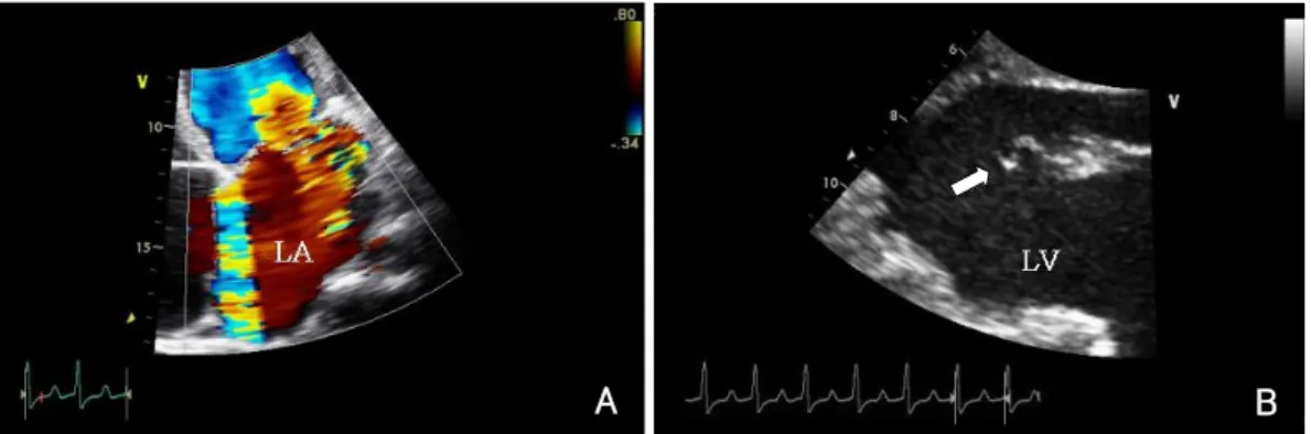Fig. 1. A: on apical 4-chamber view, color flow imaging shows a large proximal isovelocity surface area and mitral regurgitant flow