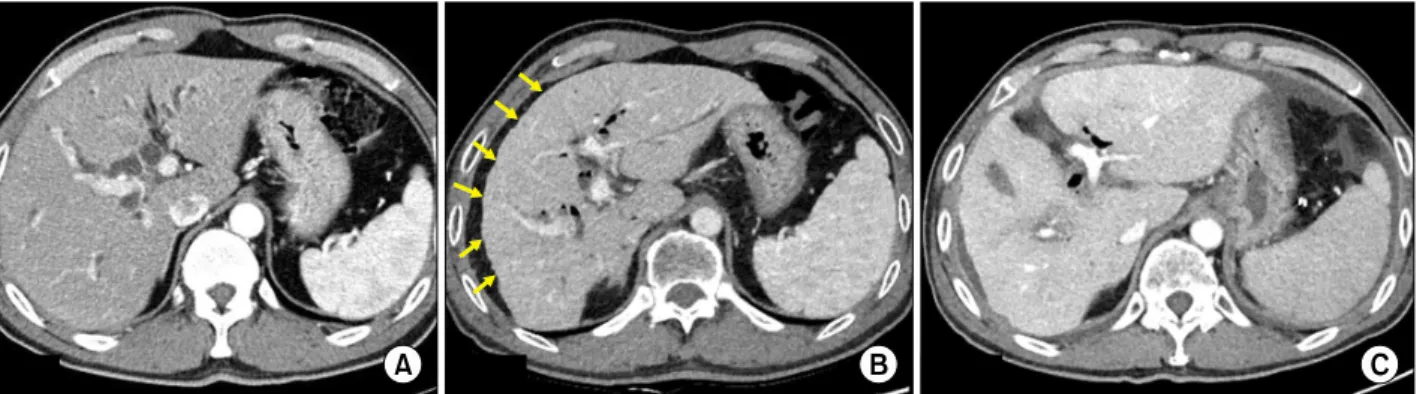 Fig. 2. Liver volume at initial CT (A), preoperative (B) and the postoperative (POD#7) CT (C)
