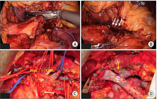 Fig. 4. Operative finding: Laparo- Laparo-scopic division of  pancreatico-splenic ligament containing both  splenic artery and vein near spleen  hilum using Endo-GIA stapler  (stapler line-white long arrow)