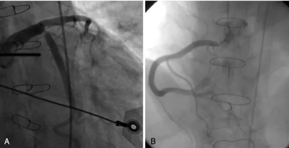 Fig. 1. Initial coronary angiography. A: selective left coronary angiography shows 95% discrete eccentric luminal narrowing at the ostium of the large LAD and large LCX