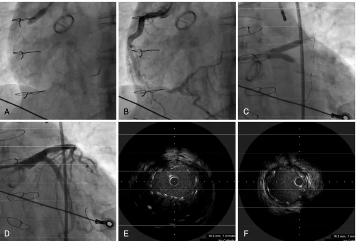 Fig. 3. Coronary angiography (A-D) and IVUS (E and F) during PCI. A and B: a large 5.0×12 mm paclitaxel-eluting stent is implanted in the os- os-tium of the RCA