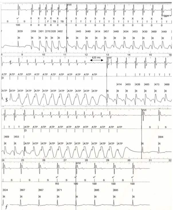 Fig. 3. Stored electrograms from episodes of ventricular tachycardia (VT). Electrogram from true ventricular bipole, marker channel, and  electrogram from ICD can to ring were arranged from top to bottom