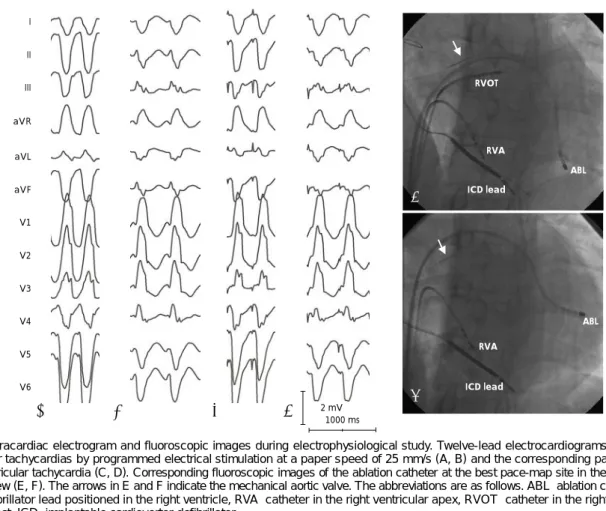 Fig. 4. Intracardiac electrogram and fluoroscopic images during electrophysiological study