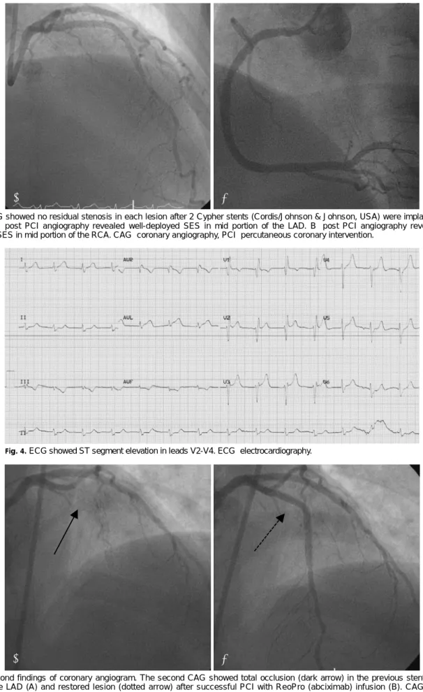 Fig. 3. CAG showed no residual stenosis in each lesion after 2 Cypher stents (Cordis/Johnson &amp; Johnson, USA) were implanted in the  lesions