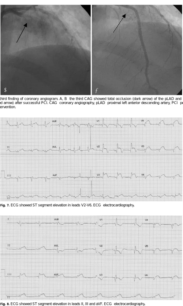Fig. 6. The third finding of coronary angiogram. A, B: the third CAG showed total occlusion (dark arrow) of the pLAD and recanalized lesion (dotted arrow) after successful PCI