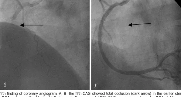 Fig. 10. The sixth CAG revealed exactly the same lesion (dark arrow) in the RCA 10 h after the PCI