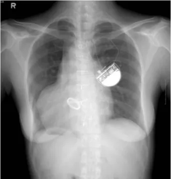 Fig. 1. Initial chest X-ray on admission. The chest X-ray showed situs inversus totalis