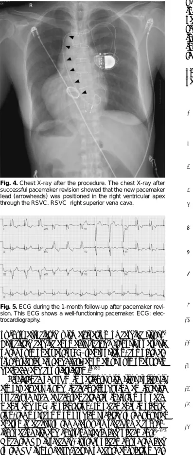 Fig. 5. ECG during the 1-month follow-up after pacemaker revi- revi-sion. This ECG shows a well-functioning pacemaker