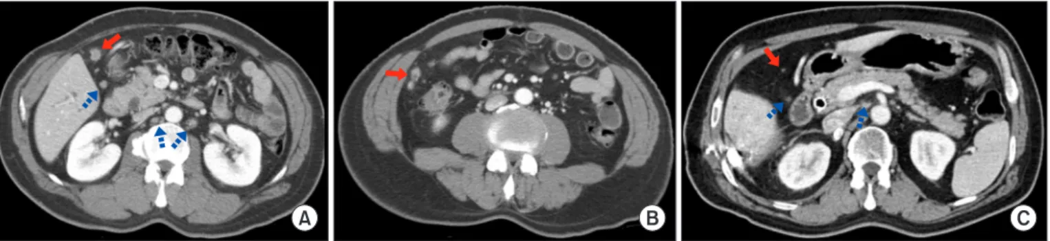 Fig. 3. Patient 11: gallbladder cancer treated with multiple chemotherapy regimens. (A) Pre-chemotherapy computed tomography (CT) shows  suspicious seeding nodule (red arrow) and regional and para-aortic lymph node (LN) enlargement (blue dotted arrows)