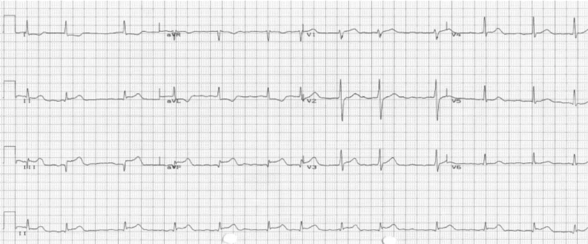 Fig. 1. An electrocardiogram showed ST segment elevation in the II, III and aVF leads.