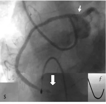 Fig. 6. An electrocardiogram showed ST segment elevation in the II, III and aVF leads.