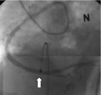 Fig. 9. The 64 slice multi-detector computed tomography showed  a patent stent lumen (arrows)