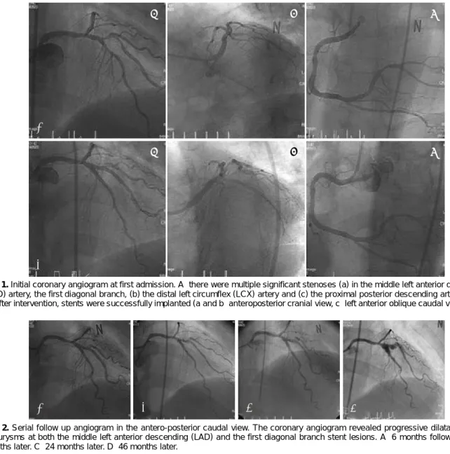 Fig. 1. Initial coronary angiogram at first admission. A: there were multiple significant stenoses (a) in the middle left anterior descending  (LAD) artery, the first diagonal branch, (b) the distal left circumflex (LCX) artery and (c) the proximal posteri