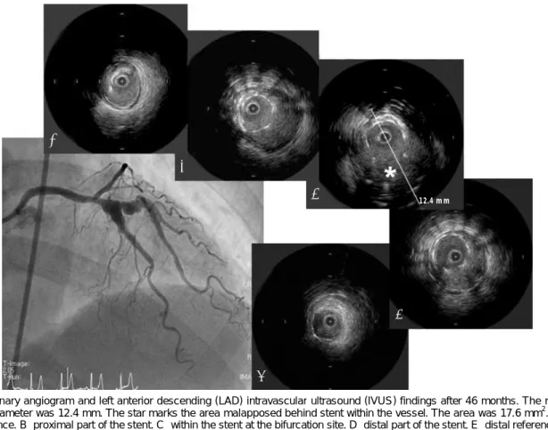Fig. 3. Coronary angiogram and left anterior descending (LAD) intravascular ultrasound (IVUS) findings after 46 months