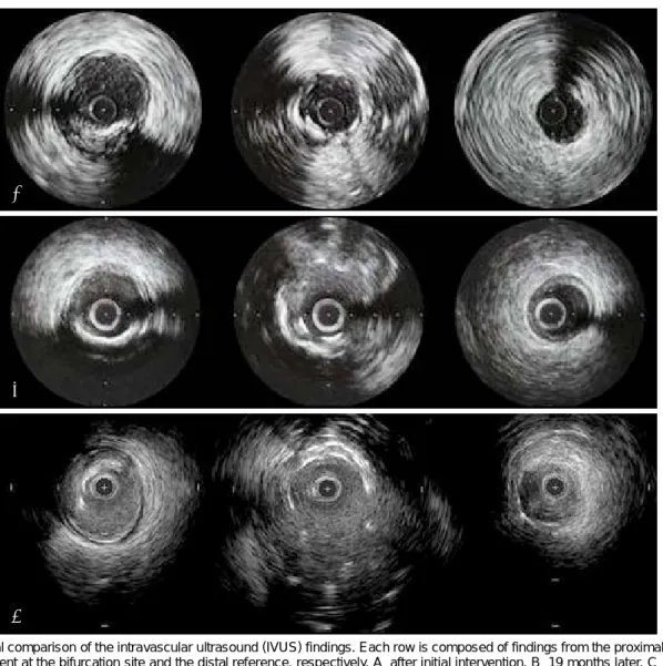 Fig. 4. Serial comparison of the intravascular ultrasound (IVUS) findings. Each row is composed of findings from the proximal reference, within the stent at the bifurcation site and the distal reference, respectively
