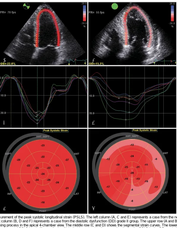 Fig. 1. Measurement of the peak systolic longitudinal strain (PSLS). The left column (A, C and E) represents a case from the normal group  and the right column (B, D and F) represents a case from the diastolic dysfunction (DD) grade II group