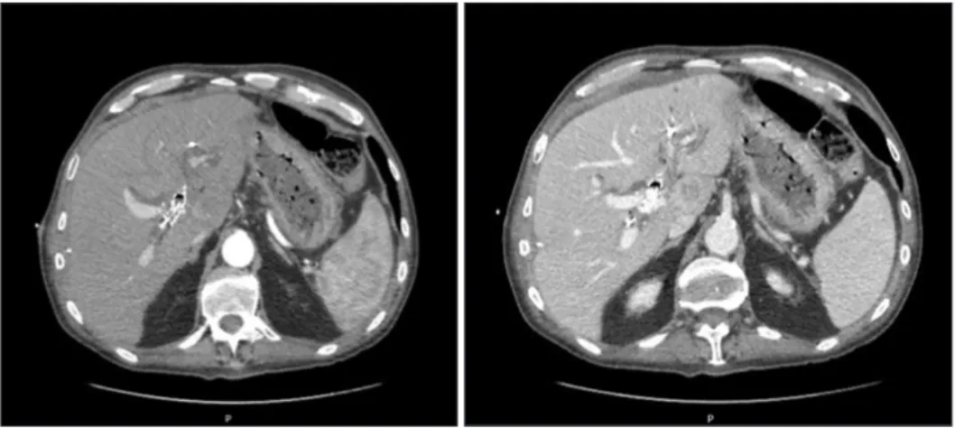 Fig. 1. Preoperative total body computed  tomography scan (arterial and portal phase)  showing the presence of metallic biliary  stent and bilateral percutaneous drainages.