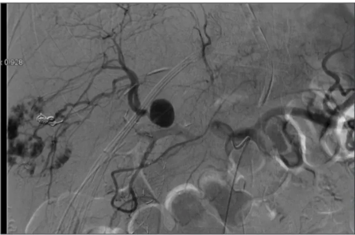 Fig. 3. Side to side arteriovenous shunt between the ileocolic artery and  the ileocolic vein using two Prolene 7/0 running sutures.