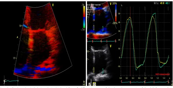 Fig. 1. The longitudinal peak strain/rates that obtained from 2 different areas of the basal segments of the LA free wall and the inter- inter-atrial septum in the apical 4 chamber view