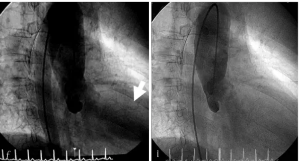 Fig. 3. The aortogram revealed by the pig-tail catheter. The aortogram showed that aortic regurgitant flow reached to the left ventricular apex via backflow (white arrow) of the aortic valve during the diastolic phase (A), but any backflow was not visualiz