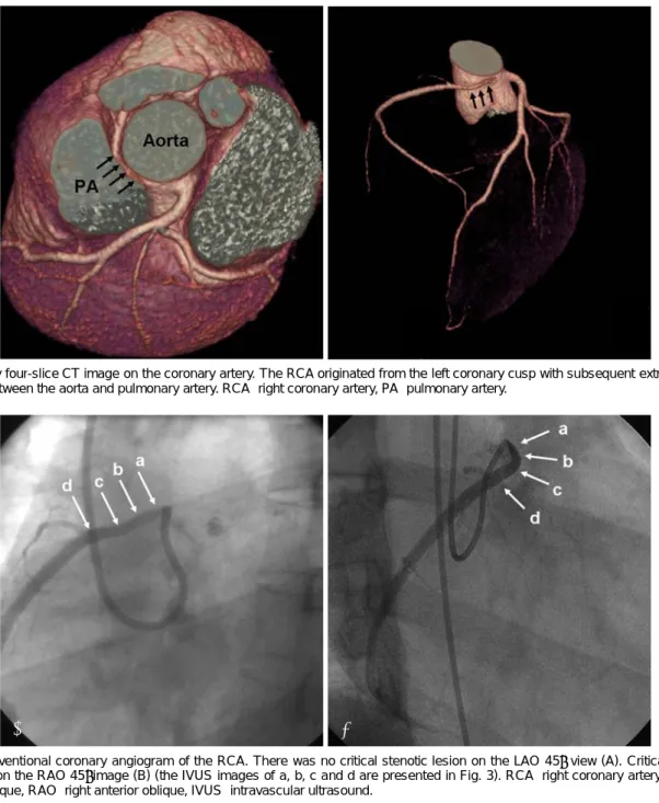 Fig. 2. Conventional coronary angiogram of the RCA. There was no critical stenotic lesion on the LAO 45° view  (A)