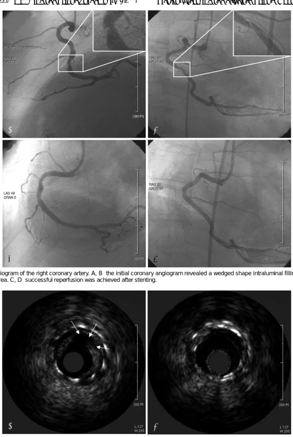 Fig. 1. Angiogram of the right coronary artery. A, B: the initial coronary angiogram revealed a wedged shape intraluminal filling defect in the stent area