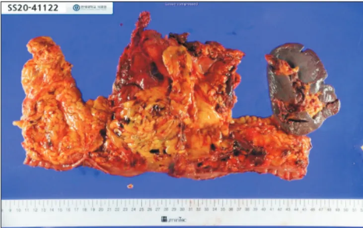 Fig. 3. (A) SpA (long white arrow) and SpV  (short white arrows) were ligated and celiac  artery dissection was done