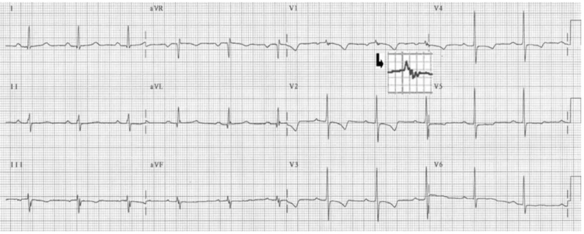 Fig. 1. Routine ECG in a patient with arrhythmognic right ventricular cardiomyopathy/dysplasia showing diffuse precordial T-wave inversion in the right precordial leads and an epsilon wave (arrow) in lead V 1 