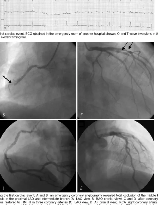Fig. 2. During the first cardiac event. A and B: an emergency coronary angiography revealed total occlusion of the middle RCA, and critical stenosis in the proximal LAD and intermediate branch (A: LAO view, B: RAO cranial view)