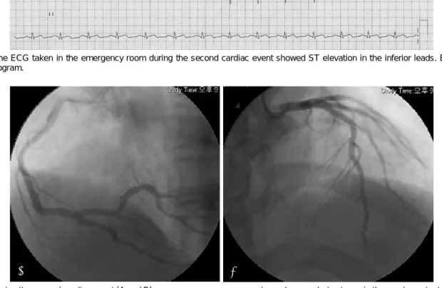 Fig. 4. During the second cardiac event (A and B) an emergency coronary angiography revealed patency in the previous stented sites of the middle right coronary artery, the proximal left anterior descending artery, and the intermediate branch with good dist