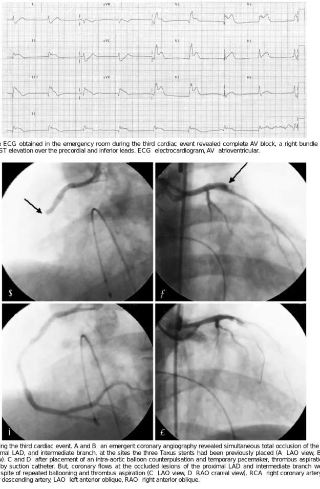 Fig. 5. The ECG obtained in the emergency room during the third cardiac event revealed complete AV block, a right bundle branch block, and ST elevation over the precordial and inferior leads