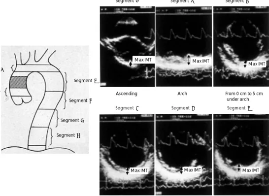 Fig. 1. The thoracic aorta was divided into six segments as depicted in the illustration on the left (length of one segment 5 cm)