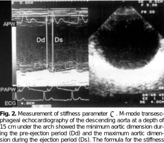 Fig. 2. Measurement of stiffness parameter  β. M-mode transeso- transeso-phageal echocardiography of the descending aorta at a depth of 15 cm under the arch showed the minimum aortic dimension  dur-ing the pre-ejection period (Dd) and the maximum aortic  d