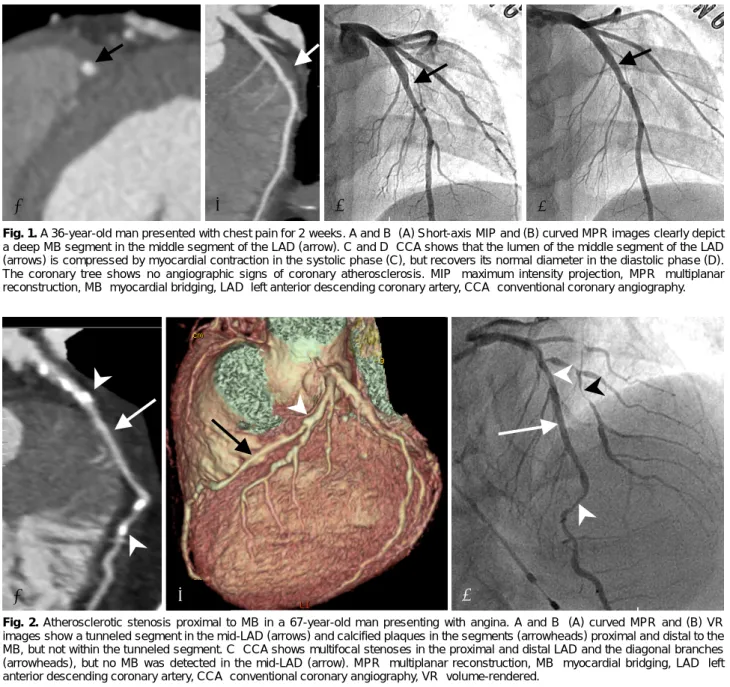 Fig. 1. A 36-year-old man presented with chest pain for 2 weeks. A and B: (A) Short-axis MIP and (B) curved MPR images clearly depict  a deep MB segment in the middle segment of the LAD (arrow)